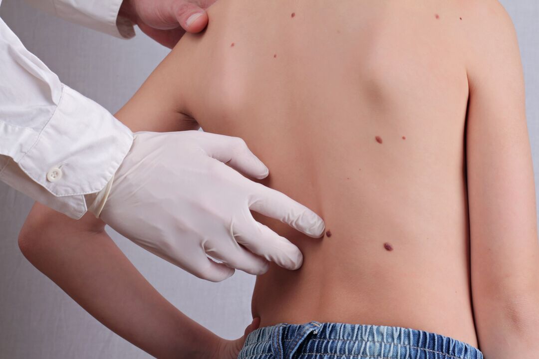 A dermatologist conducts a clinical examination of a patient with papillomas on the body. 