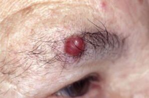 Papilloma in the eyebrows