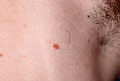 Papilloma