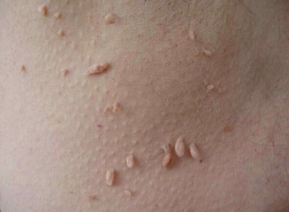 Acroords on the skin