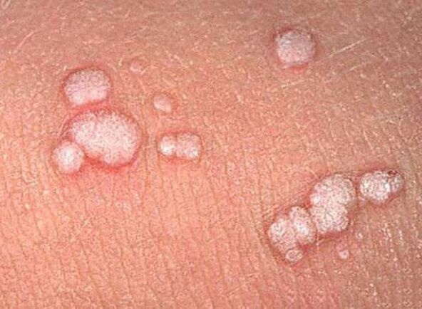 Papillomas in the human body