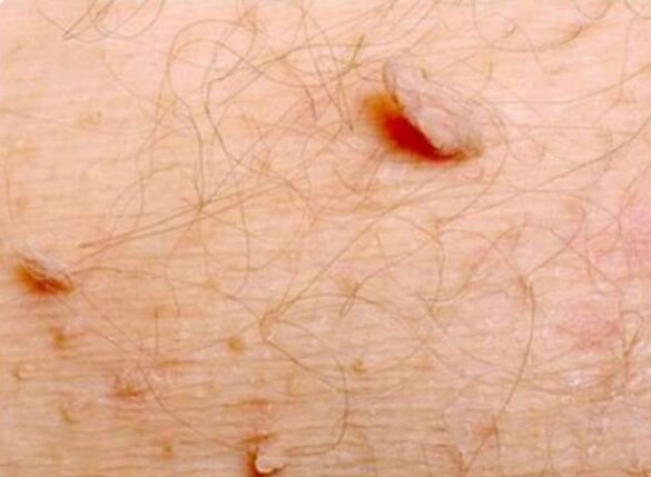 Shape papillomas in the human body