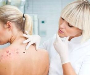 Human papillomavirus symptoms