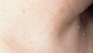 risk of developing papillomatosis in the neck