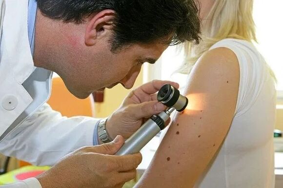 papilloma diagnosis