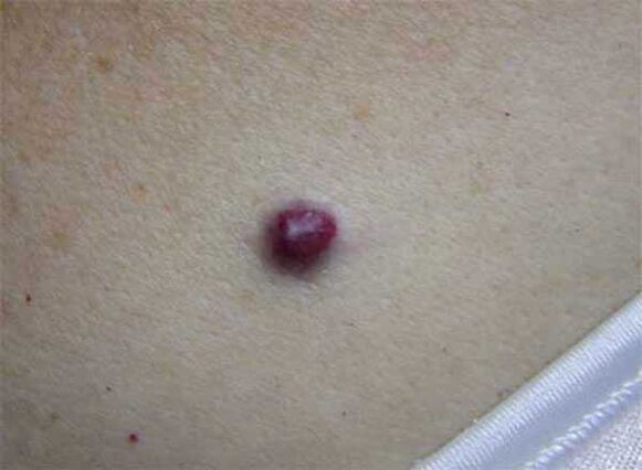 red mole on the body