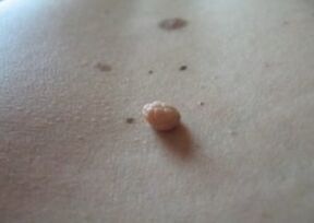 Papilloma is a growth on the surface of the skin.