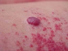 Red spots around the papilloma.