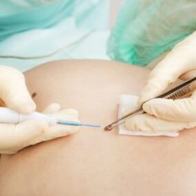 removal of papilloma by a surgeon