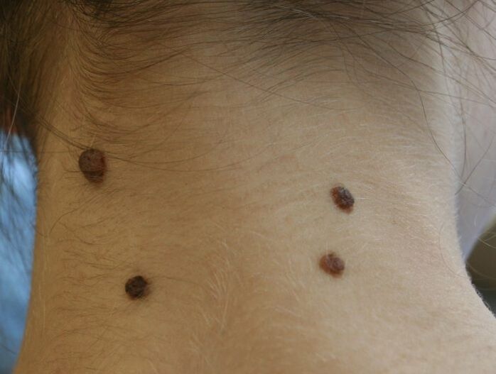 What do papillomas on the neck look like