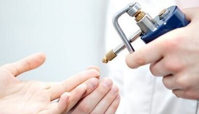 Cryodstruction as a method to treat warts