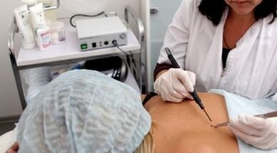 Electrocoagulation as a method to eliminate warts