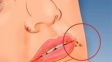 The reasons for the appearance of warts